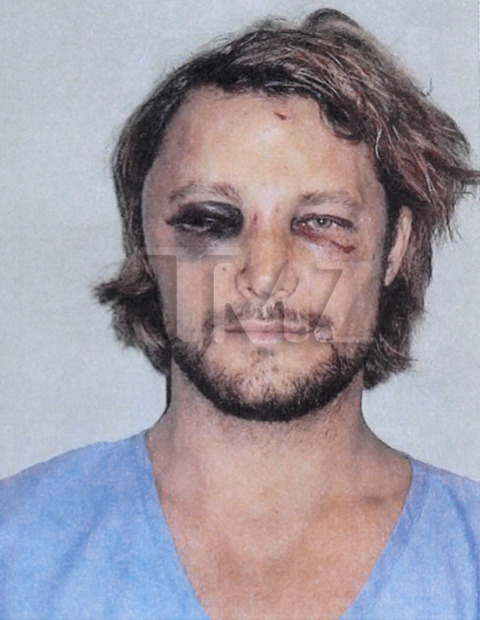 gabriel-aubry-fight-injuries-06-480w.jpg