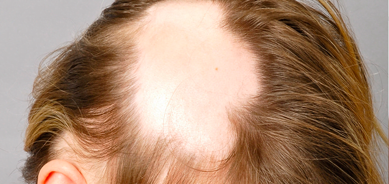 alopecia-areata-universalis.png