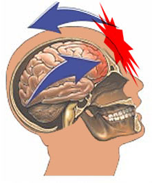 concussion.jpg