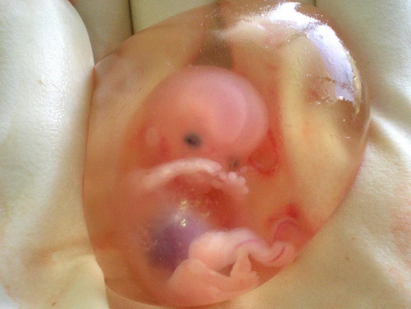 10weeksunbornbaby2.jpg