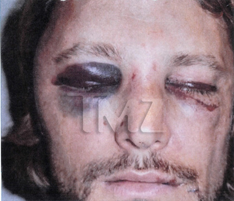 gabriel-aubry-fight-injuries-01-480w.jpg