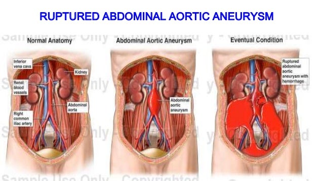 ruptured-aortic-aneurysms-13-638.jpg
