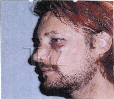 gabriel-aubry-fight-injuries-03-480w.jpg