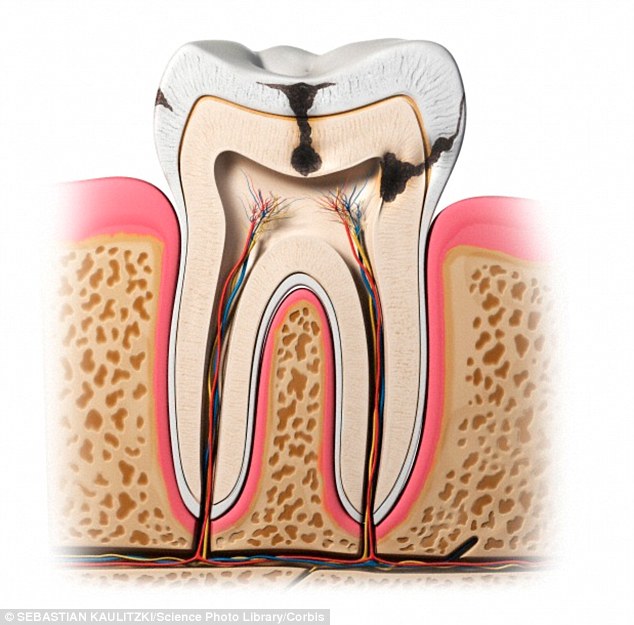 2EDCB89000000578-0-Dental_erosion_occurs_when_acid_dissolves_the_hard_tissues_of_th-a-17_1448655199182.jpg