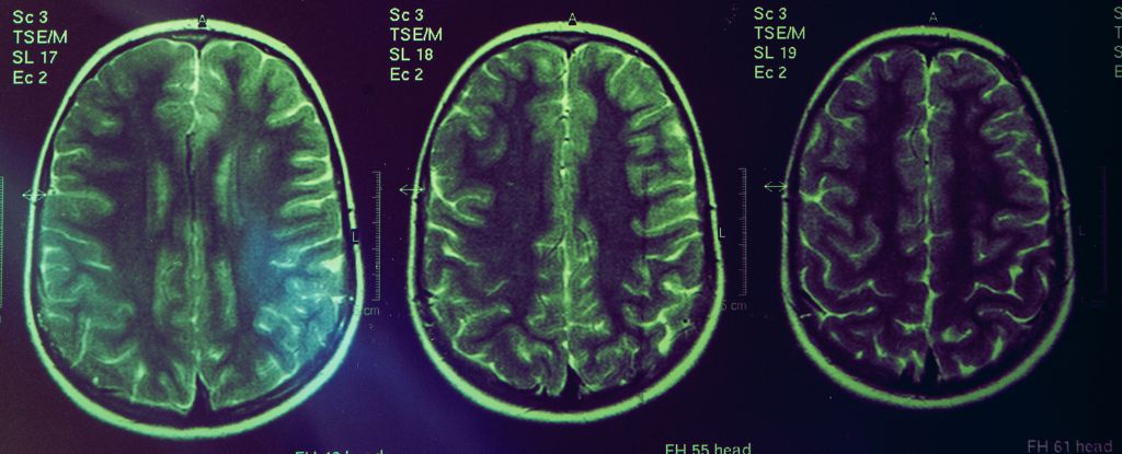GreenTintedBrainScanShowingThreeBrainImages.jpg