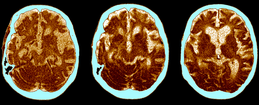 CT_alzheimers_scans.jpg