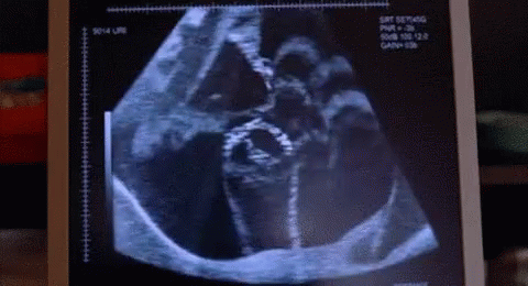 ultrasound.gif