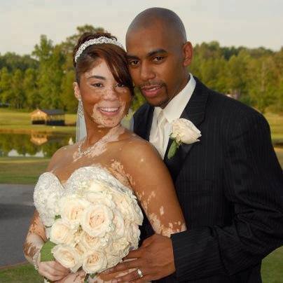 vitiligo.jpg