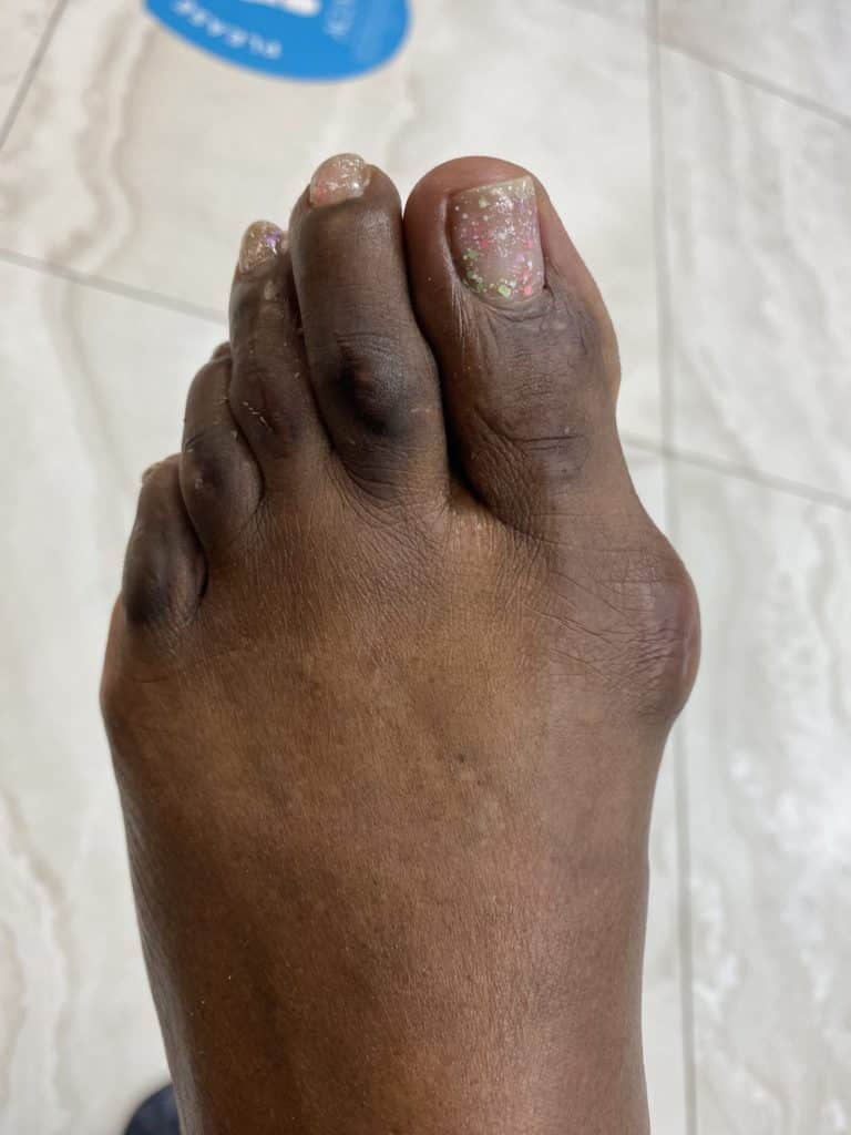 Gout-768x1024.jpg
