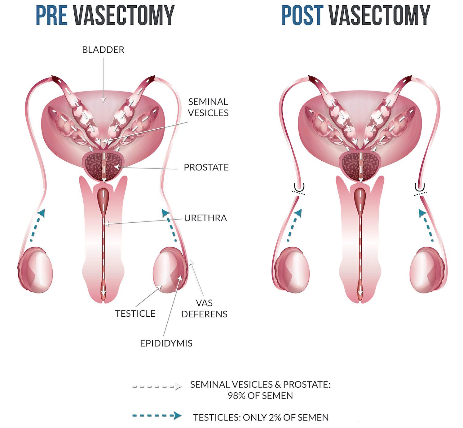how-vasectomy-works.jpg