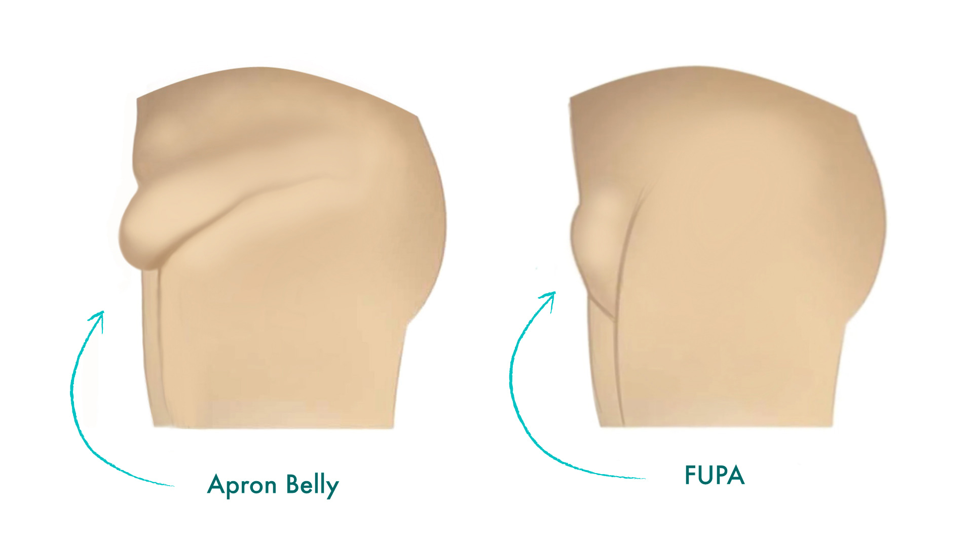 Apron-Belly-vs-FUPA-infographics.jpg