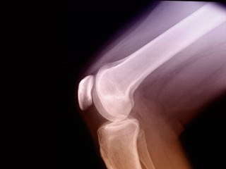 Knee+replacement.jpg