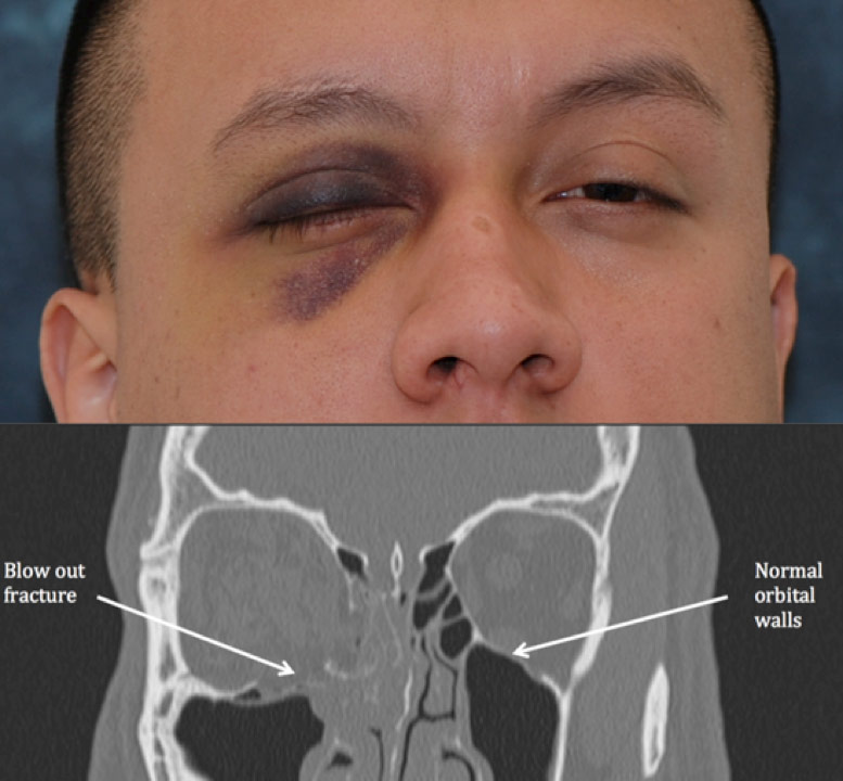 orbital-fracture-treatment.jpg