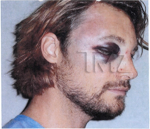 gabriel-aubry-fight-injuries-05-480w.jpg