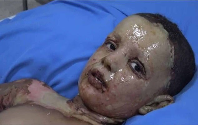 A boy with deep burns to his face, upper chest and arms is treated in a hospital in al-Hasakah