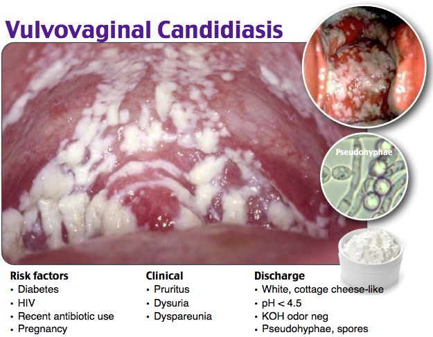 d3266439edec484f72f65da69043b15d--candida-albicans-diabetes-mellitus.jpg