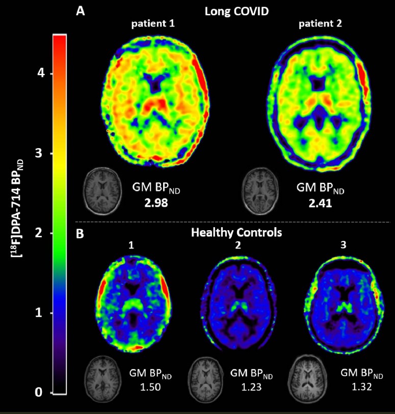 longcovidneuroinflammationtracer.jpg