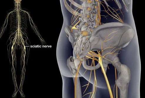 princ_rm_photo_of_sciatica_illustration.jpg