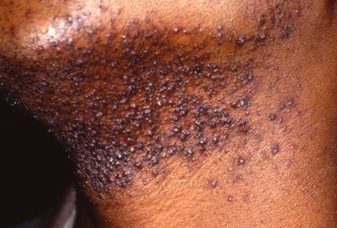 Pseudofolliculitis-barbae.jpg